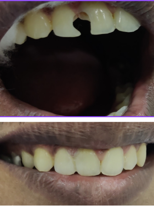 Tooth color filling